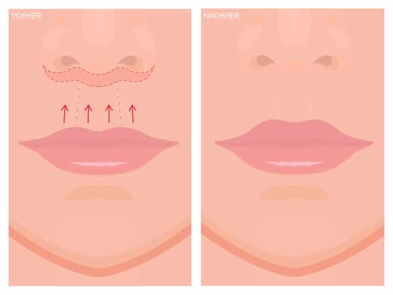 Bullhorn Lip Lift - duaerhafte Lippenvergrößerung bei Dr. Paul Wurzer